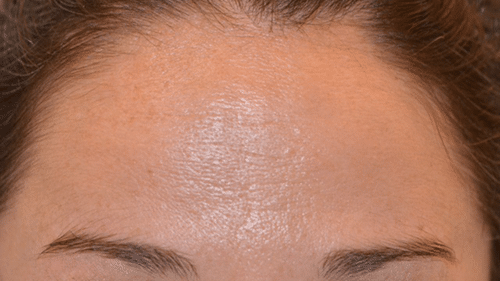 After Botox Treatment - Tamatha L Johnson Brentwood Dental Designs New Hampshire