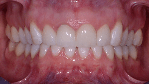 After Cosmetic Dentistry Treatment - Tamatha L Johnson Brentwood Dental Designs New Hampshire