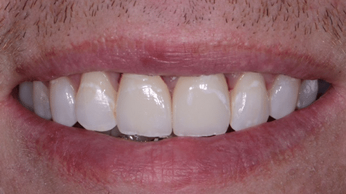 After Dental Crown Placement - Tamatha L Johnson Brentwood Dental Designs New Hampshire