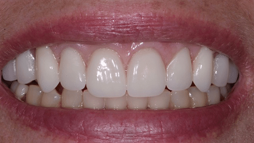 After Full Mouth Reconstruction Treatment - Tamatha L Johnson Brentwood Dental Designs New Hampshire