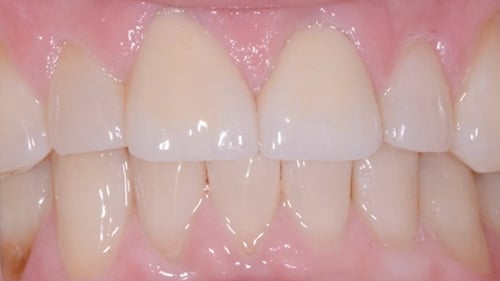 Porcelain Dental Veneers After - Tamatha L Johnson Brentwood Dental Designs New Hampshire
