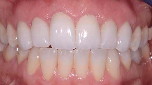 After Restorative Dentistry Treatment - Tamatha L Johnson Brentwood Dental Designs New Hampshire
