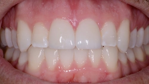 After Teeth Whitening Treatment - Tamatha L Johnson Brentwood Dental Designs New Hampshire