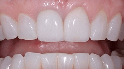 After Tooth Veneer Replacement - Tamatha L Johnson Brentwood Dental Designs New Hampshire