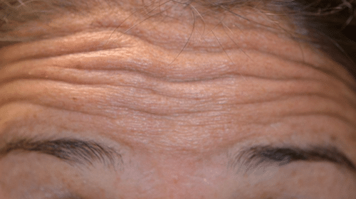 Before Botox Treatment - Tamatha L Johnson Brentwood Dental Designs New Hampshire