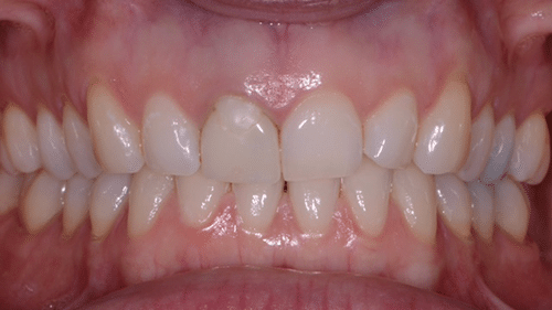 Before Cosmetic Dentistry Treatment - Tamatha L Johnson Brentwood Dental Designs New Hampshire
