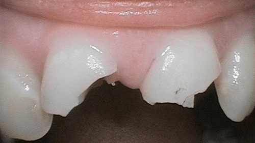 Before Dental Crown Placement - Tamatha L Johnson Brentwood Dental Designs New Hampshire