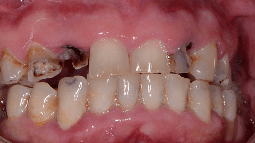 Before Full Mouth Reconstruction Treatment - Tamatha L Johnson Brentwood Dental Designs New Hampshire