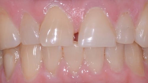 Before Porcelain Dental Veneers - Tamatha L Johnson Brentwood Dental Designs New Hampshire