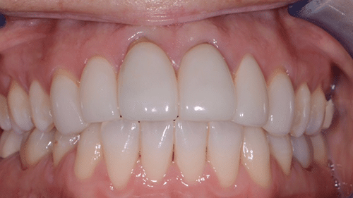 Before Restorative Dentistry Treatment - Tamatha L Johnson Brentwood Dental Designs New Hampshire