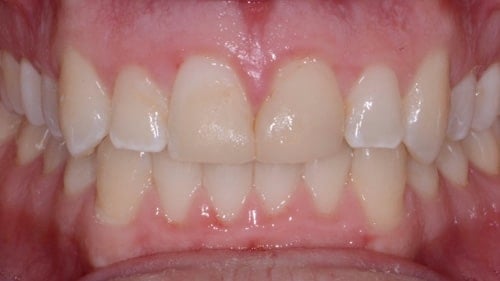 Before Teeth Whitening Treatment - Tamatha L Johnson Brentwood Dental Designs New Hampshire