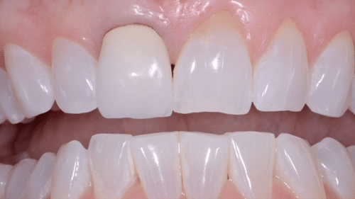 Before Tooth Veneer Replacement - Tamatha L Johnson Brentwood Dental Designs New Hampshire
