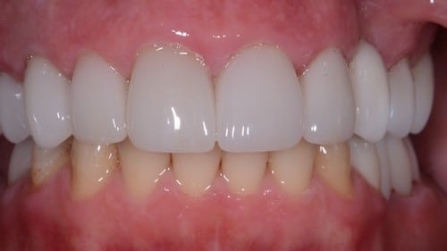 patient 1 after
