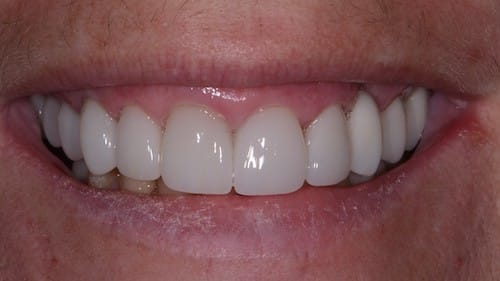 patient 2 after