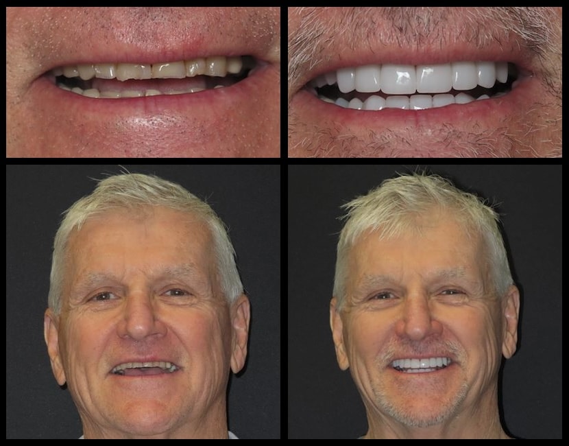 Functional Restorative case with full upper and lower Lisi porcelain restorations