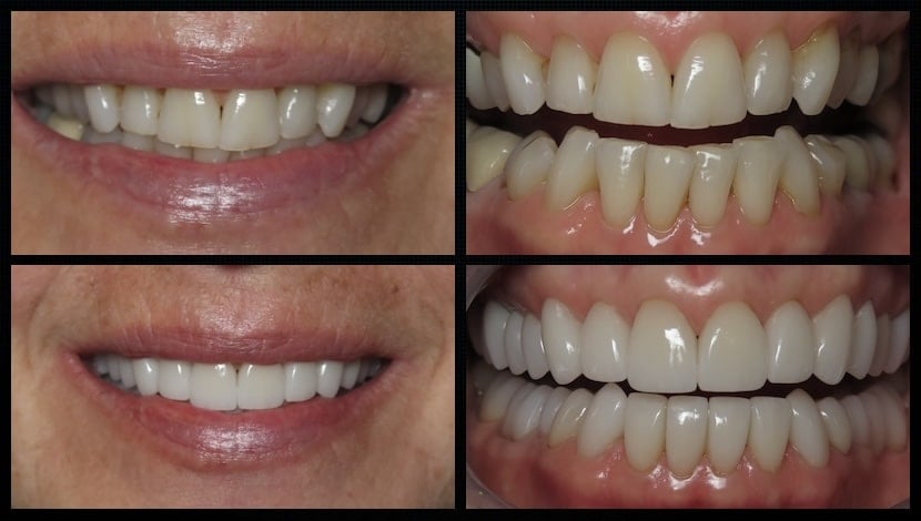 Functional Restorative case with full upper and lower Lisi porcelain restorations